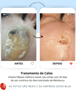 Óleo de Melaleuca Ozonizado - Imagem 4